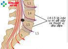 Thoát vị đĩa đệm l5 s1 - Nguyên nhân, triệu chứng và cách điều trị